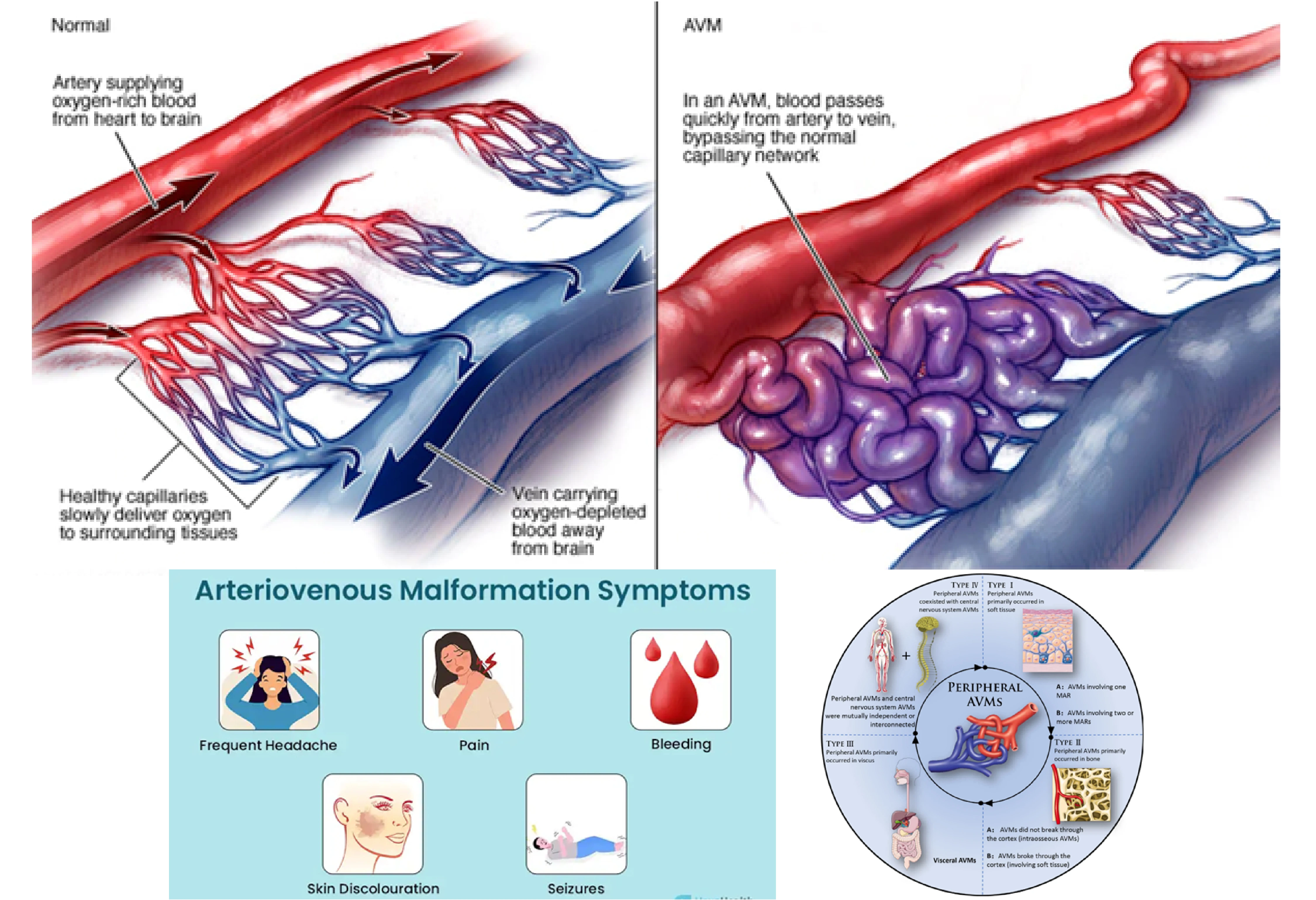 Arteriovenous Malformation (AVM): Symptoms, Risks & Treatments | IBS ...