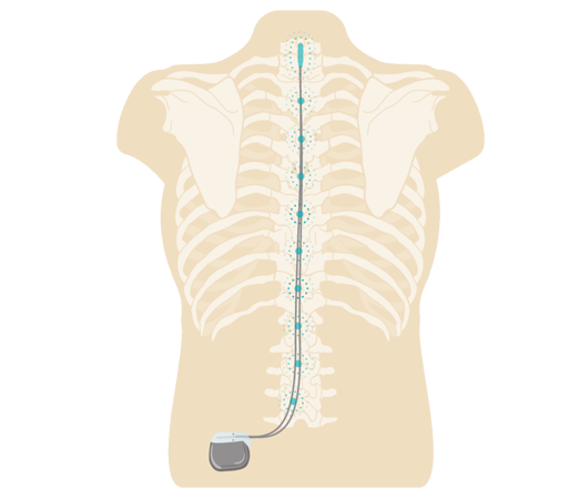 Is it Time to get a Spinal Cord Stimulator?