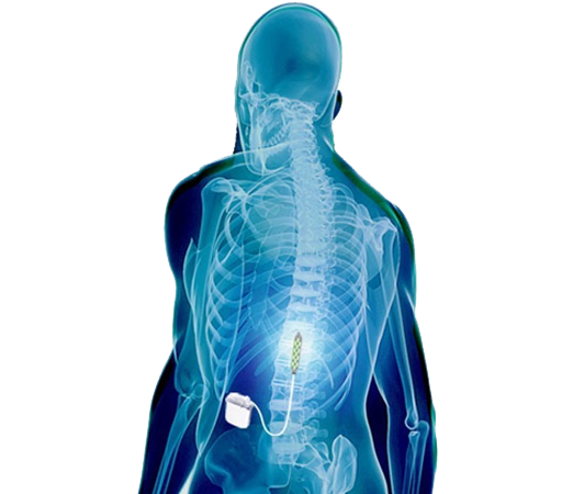 Image 08334: Implantation of Epidural Spinal Cord Stimulator Illustration