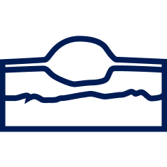 Craniopharyngiomas Treatment