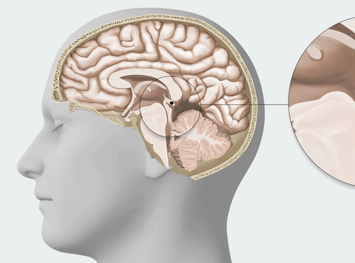 Pineal Region Tumor Treatment in Delhi | IBS Hospital