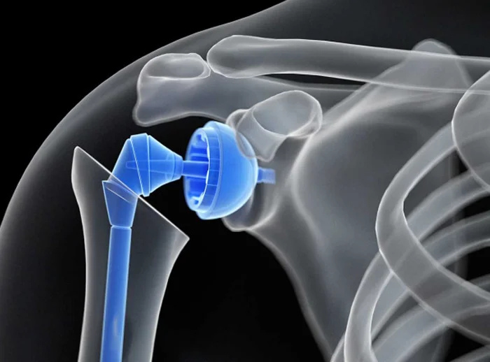 Shoulder Replacement Surgery Specialist - IBS Hospital