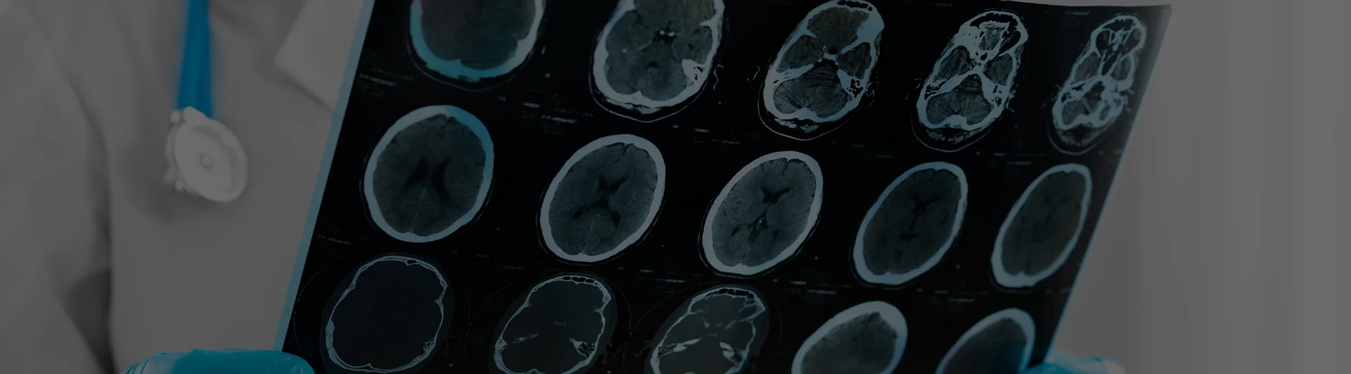 Best Neurology Hospital in Delhi, India | Stroke, Epilepsy & Brain Care ...