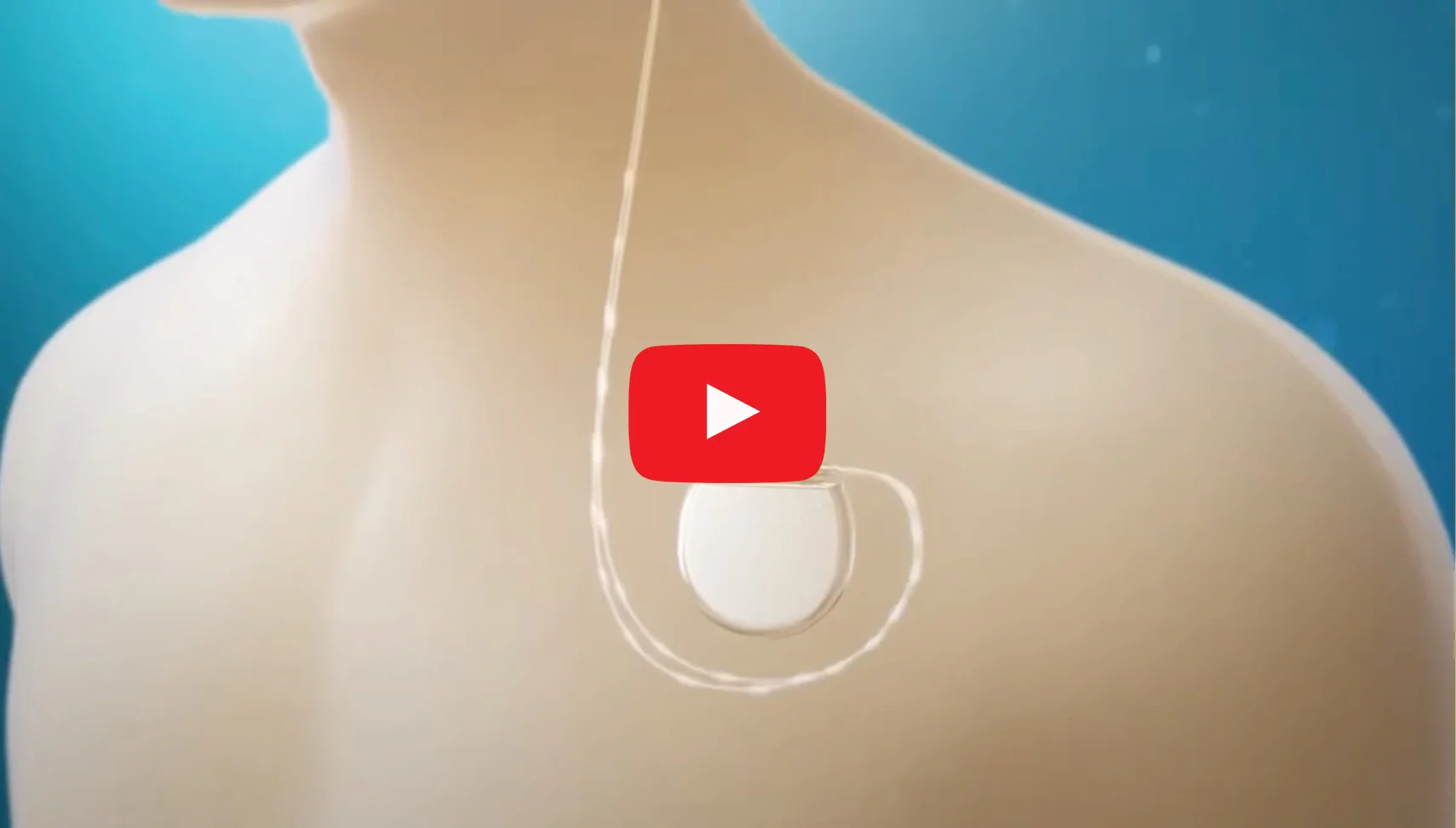 Deep Brain Stimulation (DBS) Surgery in Delhi, India - IBS Hospital